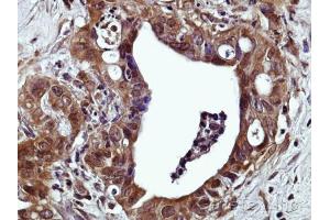 IHC-P Image Immunohistochemical analysis of paraffin-embedded Human prostate adenocarcinoma, using GPR120 , antibody at 1:500 dilution. (O3FAR1 antibody  (N-Term))