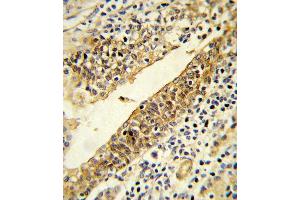 Formalin-fixed and paraffin-embedded human prostate carcinoma reacted with CYP51A1 Antibody (Center) (ABIN652820 and ABIN2842535) , which was peroxidase-conjugated to the secondary antibody, followed by DAB staining. (CYP51A1 antibody  (AA 250-279))