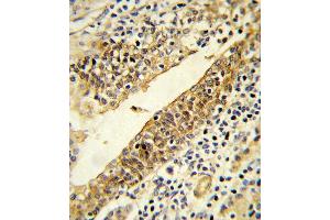 Formalin-fixed and paraffin-embedded human prostate carcinoma reacted with CYP51A1 Antibody (Center) (ABIN652820 and ABIN2842535) , which was peroxidase-conjugated to the secondary antibody, followed by DAB staining. (CYP51A1 antibody  (AA 250-279))