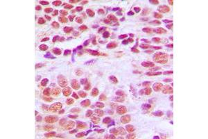 Immunohistochemical analysis of Histone Deacetylase 1 staining in human breast cancer formalin fixed paraffin embedded tissue section. (HDAC1 antibody  (C-Term))