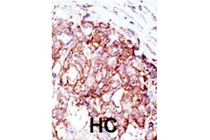 Formalin-fixed and paraffin-embedded human hepatocellular carcinoma tissue reacted with MIB1 polyclonal antibody  , which was peroxidase-conjugated to the secondary antibody, followed by AEC staining.