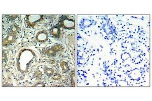 Immunohistochemical analysis of paraffin-embedded human breast carcinoma tissue using SHP-2(Phospho-Tyr580) Antibody(left) or the same antibody preincubated with blocking peptide(right). (PTPN11 antibody  (pTyr580))