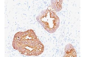 Formalin-fixed, paraffin-embedded human Prostate Carcinoma stained with Prostate Specific Antigen Mouse Monoclonal Antibody (1A7). (Prostate Specific Antigen antibody)