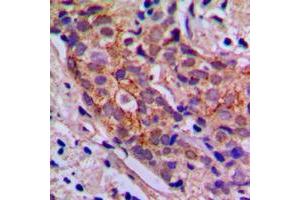 Immunohistochemical analysis of PI3K p85 alpha/p55 gamma staining in human breast cancer formalin fixed paraffin embedded tissue section.