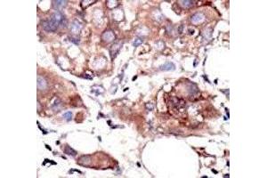 IHC analysis of FFPE human breast carcinoma tissue stained with the MUSK antibody (MUSK antibody  (AA 829-859))