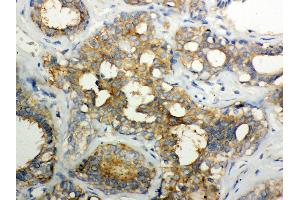 Anti- Calpain1 Picoband antibody, IHC(P) IHC(P): Human Mammary Cancer Tissue (CAPNL1 antibody  (AA 396-555))