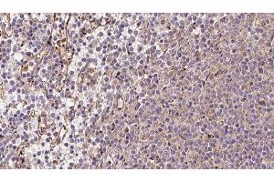 ABIN6273216 at 1/100 staining Human lymph cancer tissue by IHC-P. (CRAT antibody  (N-Term))
