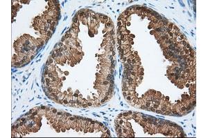 Immunohistochemical staining of paraffin-embedded Adenocarcinoma of Human colon tissue using anti-ACAT2 mouse monoclonal antibody. (ACAT2 antibody)