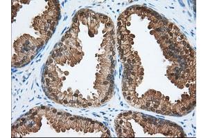 Immunohistochemical staining of paraffin-embedded Adenocarcinoma of Human colon tissue using anti-ACAT2 mouse monoclonal antibody.