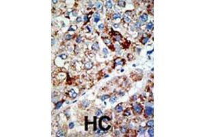 Formalin-fixed and paraffin-embedded human hepatocellular carcinoma tissue reacted with USP21 polyclonal antibody , which was peroxidase-conjugated to the secondary antibody, followed by AEC staining. (USP21 antibody  (N-Term))