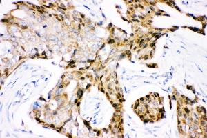 Anti- Ubiquitin Picoband antibody, IHC(P) IHC(P): Human Mammary Cancer Tissue (Ubiquitin B antibody  (AA 77-152))