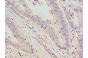 Immunohistochemistry of paraffin-embedded human colon cancer using ABIN7149695 at dilution of 1:100 (DMP1 antibody  (AA 254-513))