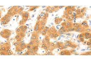 Immunohistochemistry of paraffin-embedded Human liver cancer using MAP2K6 Polyclonal Antibody at dilution of 1:30 (MAP2K6 antibody)