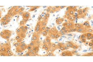 Immunohistochemistry of paraffin-embedded Human liver cancer using MAP2K6 Polyclonal Antibody at dilution of 1:30 (MAP2K6 antibody)