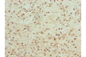 Immunohistochemistry of paraffin-embedded human glioma using ABIN7153904 at dilution of 1:100 (PGM2L1 antibody  (AA 101-400))
