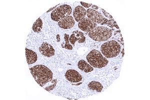 Skin Malignant melanoma with strong Melan A positivity in all tumor cells (Recombinant MLANA antibody)
