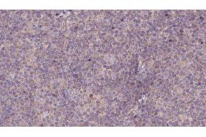 ABIN6273145 at 1/100 staining Human lymph cancer tissue by IHC-P. (NDUFS7 antibody  (Internal Region))