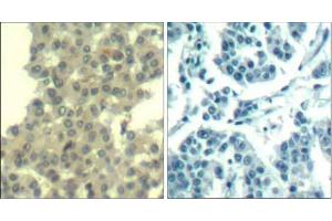 Immunohistochemical analysis of paraffin-embedded human breast carcinoma tissue using Her3/ErbB3 (Ab-1328) Antibody (E021510). (ERBB3 antibody)