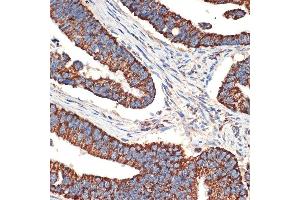 Immunohistochemistry of paraffin-embedded human colon carcinoma using BCL2L14/BCL2L14/BCLG Rabbit mAb (ABIN7265865) at dilution of 1:100 (40x lens).