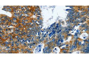 Immunohistochemistry of paraffin-embedded Human colon cancer using BPIFB3 Polyclonal Antibody at dilution of 1:120 (BPIFB3 antibody)