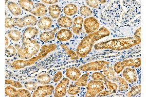 ABIN6263283 and ABIN6273140 at 1/100 staining Human kidney cancer and adjacent normal tissues by IHC-P. (MLXIP antibody  (N-Term))