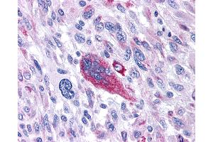 Anti-TACR1 / NK1R antibody IHC of human Brain, Glioblastoma. (TACR1 antibody  (Extracellular Domain))