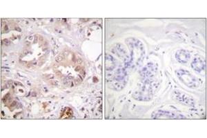 Immunohistochemistry analysis of paraffin-embedded human breast carcinoma tissue, using CDK7 (Ab-170) Antibody. (CDK7 antibody  (AA 136-185))