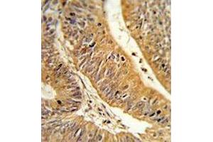 Formalin-fixed, paraffin-embedded human colon carcinoma reacted with CXXC4 Antibody (C-term), which was peroxidase-conjugated to the secondary antibody, followed by DAB staining. (CXXC4 antibody  (C-Term))