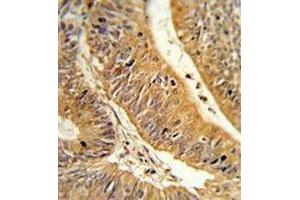 Formalin-fixed, paraffin-embedded human colon carcinoma reacted with CXXC4 Antibody (C-term), which was peroxidase-conjugated to the secondary antibody, followed by DAB staining.