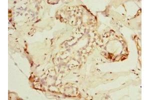 Immunohistochemistry of paraffin-embedded human breast cancer using ABIN7143282 at dilution of 1:100 (ADAD1 antibody  (AA 1-280))