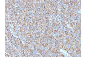 Formalin-fixed, paraffin-embedded human Melanoma stained with CD63 Mouse Monoclonal Antibody (LAMP3/2790)