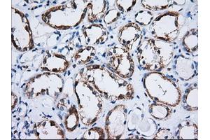 Immunohistochemical staining of paraffin-embedded Carcinoma of Human thyroid tissue using anti-TTC32 mouse monoclonal antibody. (TTC32 antibody)