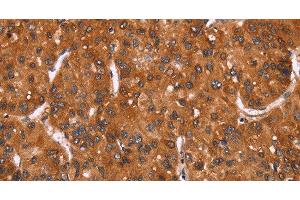 Immunohistochemistry of paraffin-embedded Human liver cancer tissue using HRK Polyclonal Antibody at dilution 1:40 (HRK antibody)