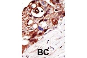 Formalin-fixed and paraffin-embedded human cancer tissue reacted with the primary antibody, which was peroxidase-conjugated to the secondary antibody, followed by DAB staining. (PIGK antibody  (N-Term))