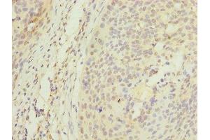 Immunohistochemistry of paraffin-embedded human cervical cancer using ABIN7150355 at dilution of 1:100 (APEX1 antibody  (AA 32-318))