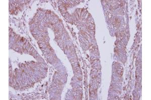 IHC-P Image Immunohistochemical analysis of paraffin-embedded human colon carcinoma, using DPY19L4, antibody at 1:250 dilution. (DPY19L4 antibody  (C-Term))