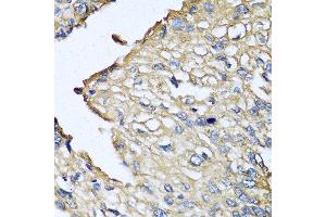 Immunohistochemistry of paraffin-embedded human prostate cancer using ASIP antibody at dilution of 1:100 (40x lens).