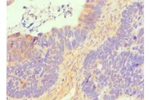 Immunohistochemistry of paraffin-embedded human ovarian cancer using ABIN7170114 at dilution of 1:100 (GLUT1 antibody  (AA 210-310))
