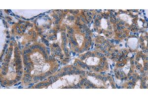 Immunohistochemistry of paraffin-embedded Human thyroid cancer tissue using PLIN1 Polyclonal Antibody at dilution 1:30 (PLIN1 antibody)
