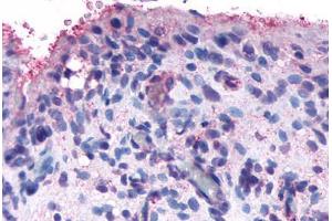Anti-FZD5 / Frizzled 5 antibody  ABIN1048626 IHC staining of human synovium, rheumatoid arthritis. (FZD5 antibody  (Cytoplasmic Domain))