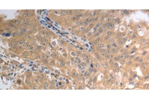 Immunohistochemistry of paraffin-embedded Human ovarian cancer using SLC1A4 Polyclonal Antibody at dilution of 1:70 (SLC1A4 antibody)