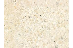 ABIN6264637 and ABIN6273153 at 1/100 staining human astrocytoma by IHC-P. (RAP1B antibody  (C-Term))
