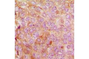 Immunohistochemical analysis of MRPL48 staining in human breast cancer formalin fixed paraffin embedded tissue section. (MRPL48 antibody  (C-Term))