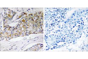 Peptide - +Immunohistochemistry analysis of paraffin-embedded human breast carcinoma tissue using DHRS11 antibody. (DHRS11 antibody)