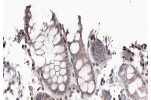 ABIN6267667 at 1/200 staining human colon cancer tissue sections by IHC-P. (CDC37 antibody  (pSer13))