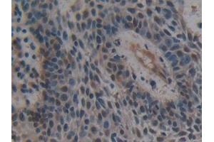 Detection of UBE1L in Human Skin cancer Tissue using Polyclonal Antibody to Ubiquitin Activating Enzyme E1 Like Protein (UBE1L) (ATG7 antibody  (AA 429-488))