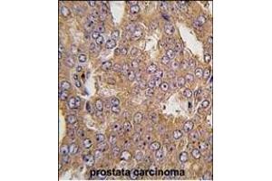 Formalin-fixed and paraffin-embedded human prostata carcinoma tissue reacted with NARS2 antibody (C-term) (ABIN391847 and ABIN2841682) , which was peroxidase-conjugated to the secondary antibody, followed by DAB staining.