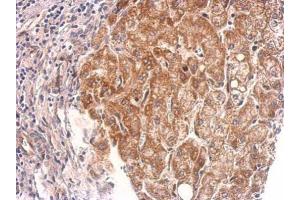 IHC-P Image Cyclophilin 40 antibody detects PPID protein at cytosol on human hepatoma by immunohistochemical analysis. (PPID antibody)