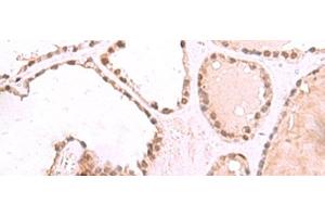 Immunohistochemistry of paraffin-embedded Human thyroid cancer tissue using RUVBL1 Polyclonal Antibody at dilution of 1:85(x200)