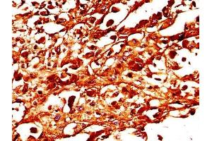 IHC image of ABIN7173988 diluted at 1:300 and staining in paraffin-embedded human melanoma performed on a Leica BondTM system. (TYR antibody  (AA 19-377))